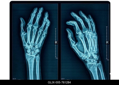 Hand X-ray of an adult female-stock-foto
