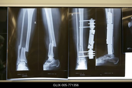 X-ray of a leg fracture and external fixation-stock-foto