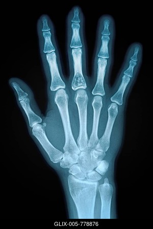 Hand X-ray of an adult female-stock-foto