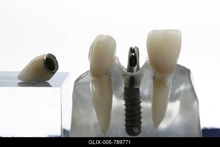 Dentures, Crown on Implant-stock-foto