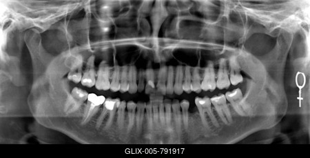X-ray image, teeth-stock-foto
