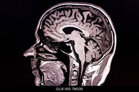 Lateral black and white MRI scan of a human brain and skull-stock-foto