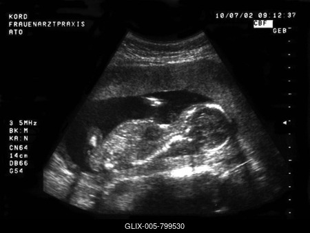 Ultrasound image of a fetus-stock-foto