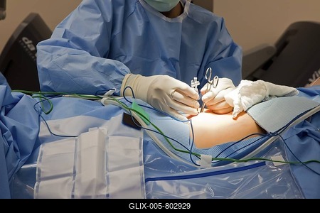 A doctor makes an incision to prepare a cancer patient for robotic surgery at St. John Hospital, Detroit, Michigan, USA, America-stock-foto