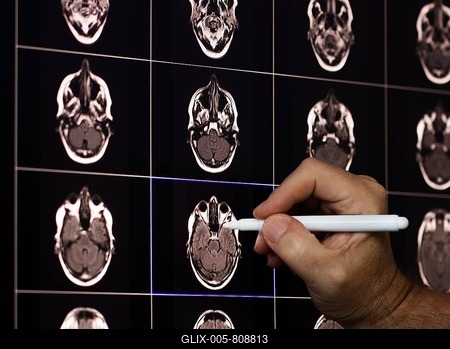A hand points with a pen to MRI scans of brains displayed on a screen-stock-foto