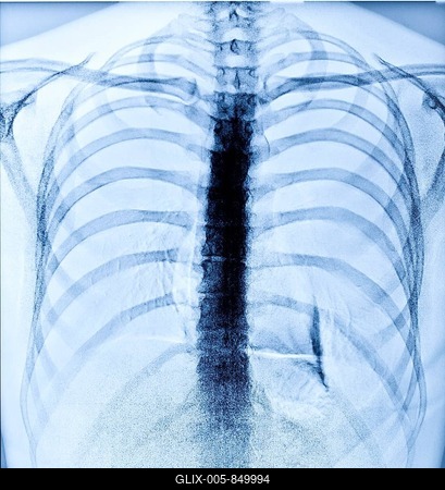 X-Ray Image Of Human Healthy Chest-stock-foto