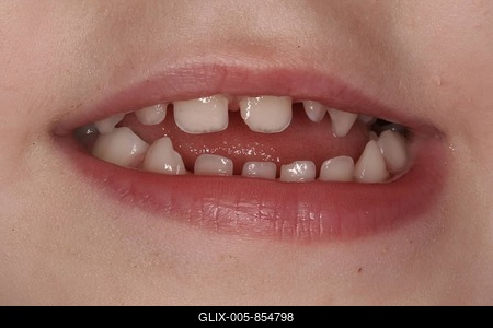 Bad teeth-stock-foto