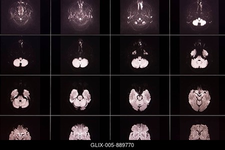 Several black and white MRI scans of a brain in different layers and angles, organised in a matrix-stock-foto