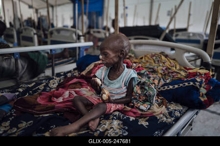  Sudanese refugees in Chad - 20/06/2024 - chad / ? Adre ? - An acutely malnourished Sudanese child in the pediatric war-stock-foto
