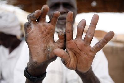 The hands of an elderly man suffering from leprosy-stock-foto