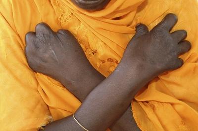 An elderly female leper wearing yellow sari, waiting for treatment for her with mutilated hands. Leprosy (Hansen s dise-stock-foto
