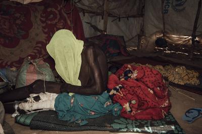  Sudanese refugees in Chad - 20/06/2024 - chad / ? Adre ? - A Sudanese refugee injured in the leg. Adre transit camp, J-stock-photo
