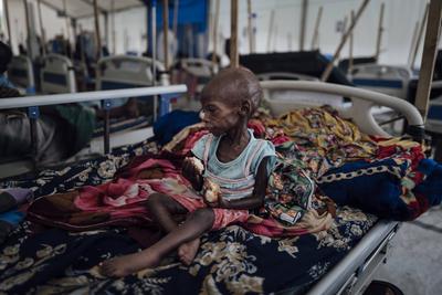  Sudanese refugees in Chad - 20/06/2024 - chad / ? Adre ? - An acutely malnourished Sudanese child in the pediatric war-stock-photo