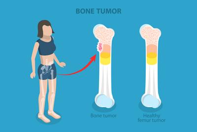 3D Isometric Flat  Illustration of Bone Tumor, Orthopedic Problem<br>3D Isometric Flat  Illustration of Bone Tumor, Orthopedic Problem-stock-foto
