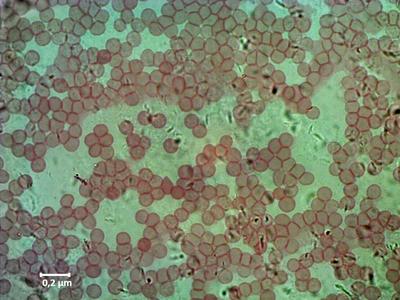 mikroskopische Aufnahme von Blutkrebs, Leukaemie, Blutausstrich, 2000x leukemia, blood smear, 2000x BLWS606442 Copyright-stock-foto