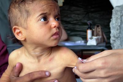 UNRWA health staff screen and treat children suffering from Severe Acute Malnutrition (SAM) at an UNRWA Medical Point located in an UNRWA school-turned-shelter-stock-foto
