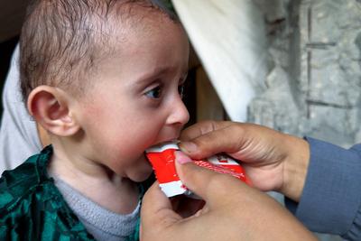 UNRWA health staff screen and treat children suffering from Severe Acute Malnutrition (SAM) at an UNRWA Medical Point located in an UNRWA school-turned-shelter-stock-foto