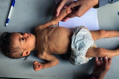 UNRWA health staff screen and treat children suffering from Severe Acute Malnutrition (SAM) at an UNRWA Medical Point located in an UNRWA school-turned-shelter-stock-foto