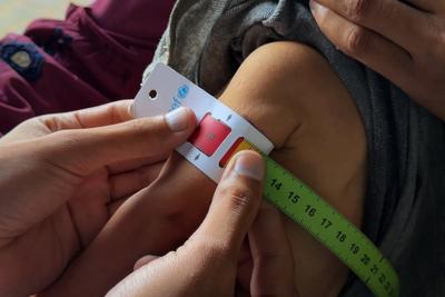 UNRWA health staff screen and treat children suffering from Severe Acute Malnutrition (SAM) at an UNRWA Medical Point located in an UNRWA school-turned-shelter-stock-foto
