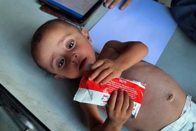 UNRWA health staff screen and treat children suffering from Severe Acute Malnutrition (SAM) at an UNRWA Medical Point located in an UNRWA school-turned-shelter-stock-foto