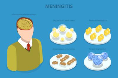 3D Isometric Flat  Illustration of Meningitis, Meningococcal Disease, Dangerous Meninges Inflammation<br>3D Isometric Flat  Illustration of Meningitis, Meningococcal Disease, Dangerous Meninges Inflammation-stock-foto