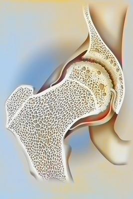 Hip osteoarthritis drawing-stock-foto