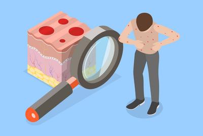 3D Isometrische flache konzeptionelle Illustration von Windpocken, roter Ausschlag<br>3D-Isometrische flache konzeptionelle Illustration von Windpocken, roter Ausschlag-stock-foto